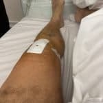 Knee Replacement Surgery